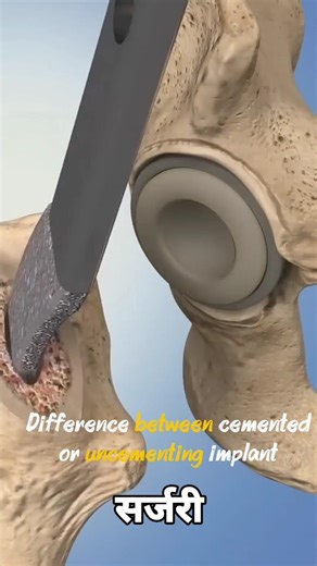 Cemented vs Uncemented Bipolar Surgery#hipbipolar#hipreplacement#cementedimplant#uncementedimplant