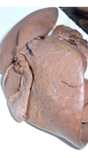 Liver Dissection Clinical Anatomy #mbbs #bds