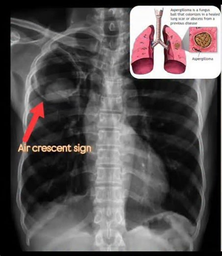 RK NURSE'S HUB on Instagram: "The air crescent sign is a characteristic radiographic finding (on CT or chest X-ray) consisting of a crescent-shaped radiolucent (air) space separating an internal mass from the surrounding wall of a lung cavity. It most frequently indicates a fungus ball (aspergilloma) within a preexisting cavity, but it is highly associated with angioinvasive aspergillosis in neutropenic patients, representing lung tissue necrosis and retraction. Key Aspects of the Air Crescent S