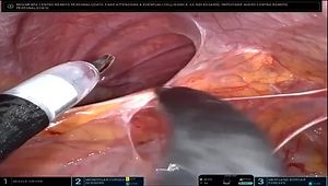 Single-port Robotic Neovesico-vaginal Fistula Repair & Left Ureteral Reimplantation
