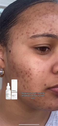 The Ordinary Salicylic Acid for Dark Spots: Before and After Review