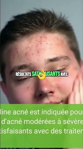 Doxycycline Le Guide Complet pour Traiter l'Acné