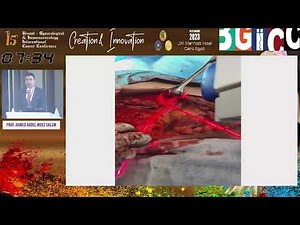 Targeted axillary dissection to minimize axillary surgery post neoadjuvant systemic therapy