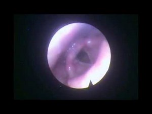 Tricia's Vocal Folds Low and High flexible stroboscopy