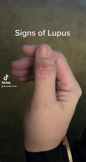 Understanding Lupus: Symptoms, Causes, and Awareness