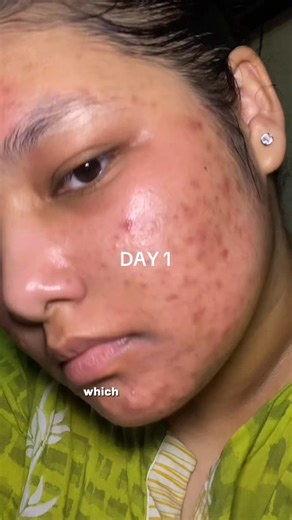 362K views · 47 reactions | SAVE FLAT 40% on every purchase of the ACNE CALMING SERUM by getting a FREE FULL SIZE lip treatment with it! you heard us right, so samples no minis a free FULL SIZE product! | Organic Traveller - Skincare | Facebook