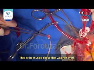Subaortic Web Resection & Septal Myectomy
