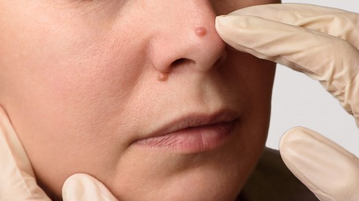 Why Do Facial Warts Occur And How To Remove Them: Dermatologist Explains