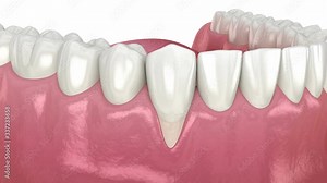 Gum Recession: Soft tissue graft surgery. 3D animation of Dental procedure