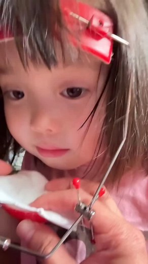 Dentistrypedia on Instagram: "Reverse pull headgear, also known as a facemask or orthopedic facemask, is an orthodontic appliance used to correct underbites and other malocclusions where the upper jaw is too far back. It works by applying a forward-pulling force to the upper jaw, guiding its growth and alignment. How it works: ~Mechanism: The headgear attaches to the upper jaw (often with brackets or hooks) and is supported by a metal or plastic frame that sits against the forehead and chin. Ela