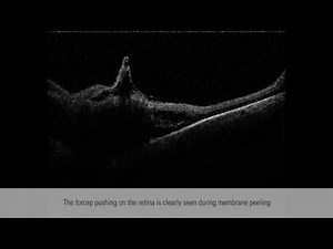 Epiretinal membrane peel supported with intrasurgical OCT