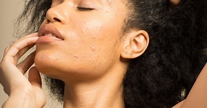 You Have To See What Happened To This Woman's Skin After Going On The Pill