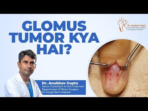 Glomus Tumor Explained | Everything You Need To Know| Dr. Anubhav Gupta