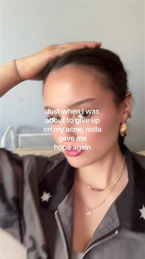 How Nolla Transformed My Acne Journey