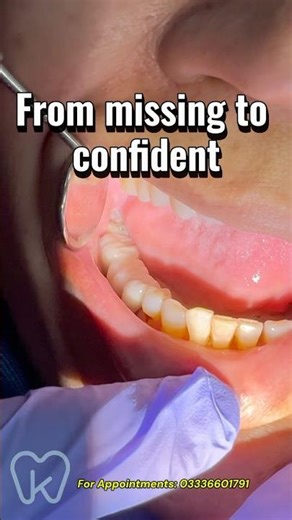 From missing tooth to complete smile 🦷✨ | Dental Bridge #dentist #dentalbridge #missingtooth