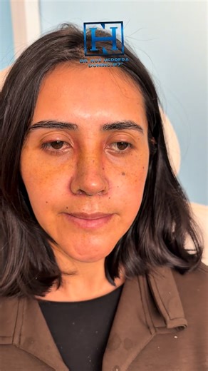 Dr. Noé Herrera Domínguez on Instagram: "Rinoplastia ultrasónica con técnica L graft 😍😍😍 9 días después de cirugía ⏰ Cirugía funcional y estética. ——- Ultrasonic rhinoplasty with L-graft technique 😍😍😍 9 days post-surgery ⏰ Functional and cosmetic surgery. **** El resultado final depende de múltiples variables como el tipo de cicatrización; los cuidados postoperatorios; la adecuada integración de los injertos. Para un presupuesto es necesario una cita de valoración. —- The final result de