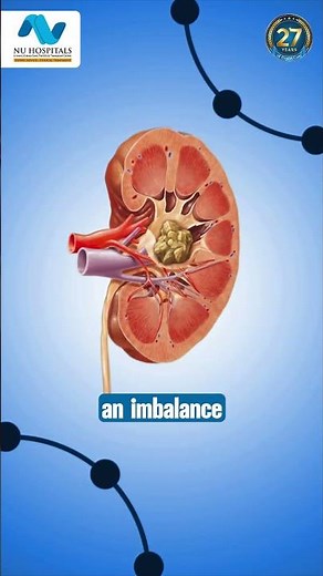 KIDNEY STONES: How They Form & How to Prevent Them