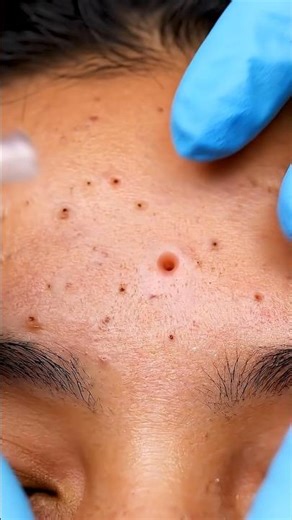 These Forehead Pores Were Completely Clogged