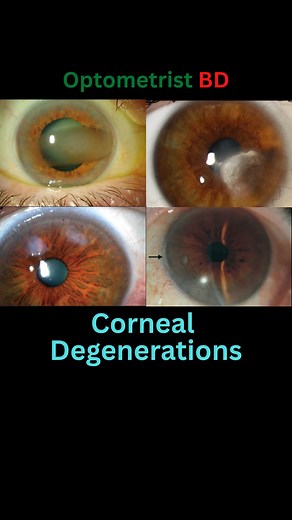 48K views · 1K reactions | Corneal Degenerations #optometristbd #cornealdegenerations @topfans | Optometrist BD | Facebook