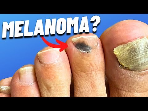 Do I Have a Melanoma?