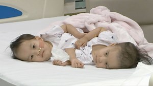 86K views · 6.1K reactions | Surgeons in Australia have successfully separated conjoined twins from Bhutan in a life-changing operation. The 15-month-old girls, Nima and Dawa Pelden, had been joined at the torso and shared a liver. Lead surgeon Dr. Joe Crameri said the surgery was successful and the twins were "doing very well." | CGTN | Facebook