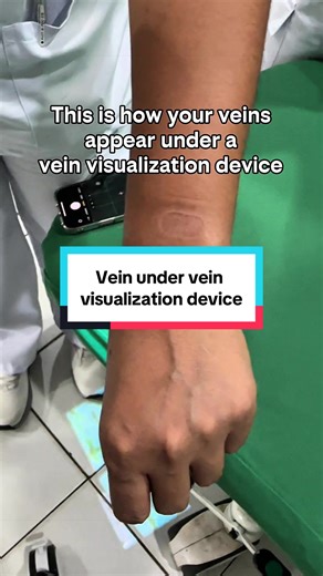 This is how your veins appear under a vein visualization device