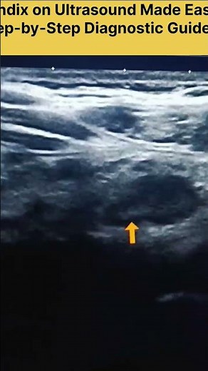 Appendix on Ultrasound Made Easy | Step-by-Step Diagnostic Guide ‎#Appendicitis #UltrasoundDiagnose