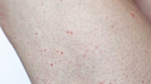 「赤い発疹、吹き出物、刺激で覆われた脚の皮膚の接写。疥癬・アレルギー・美容学の概念」の動画素材（ロイヤリティフリー）1092846031 | Shutterstock