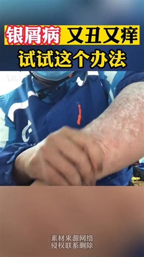 🌿 银屑病一直困扰你？现在是时候让皮肤“安静下来”了！ 🌿 😣 皮肤发红、瘙痒、脱屑，让你每天情绪都被影响？ 🤷‍♂️ 换了无数产品，效果却总是反复？ 😞 每次看到皮肤斑块，都不敢自信面对别人？ 💚 现在有一种更温和、更天然、适合长期使用的舒缓方式！ 这款草本修复霜专为敏感、易反复的肌肤打造： ✨ 主要功效： 🌿 快速缓解炎症与瘙痒 🌿 改善粗糙、增厚、脱屑的皮肤问题 🌿 深层保湿，减轻干裂与紧绷感 🌿 不含类固醇，安全不刺激 🌸 当皮肤不再疼、不再红、不再发作，你的生活也会轻松许多 💕 🎁 把握今天的优惠，亲自感受它带来的改变吧！ https://www.am-care.store/psoriasis-cml02-amcare-fb-china | 银屑病药膏 - Malaysia