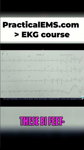 Brugada Syndrome: Identifying Key EKG Findings (V1-V3)