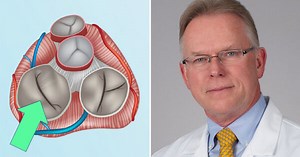 Surgeon Q&A: Treating Mitral Valve Disease in 2020