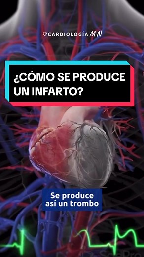 ¿Cómo se produce un infarto? Causas y Síntomas