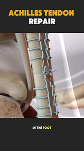 Achilles tendon repair is a surgical procedure used to treat a ruptured Achilles tendon. This video explains how the surgery is performed, including tendon alignment and repair techniques. For educational and awareness purposes only. #AchillesTendonRepair #AchillesSurgery #OrthopedicCare #FootAndAnkle #MedicalAwareness #SurgicalProcedure #HealthcareEducation | MedVision