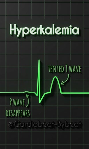 📉🌟 Main Characteristic ECG Changes in Electrolyte Imbalances: Potassium and Calcium Levels: Hypokalemia (Low Potassium): Prominent U waves (best seen in the precordial leads V2-V3)📉 Hyperkalemia (High Potassium): Peaked T waves 📈 Hypocalcemia (Low Calcium): Prolonged QT interval 🔍 Hypercalcemia (High Calcium): Shortened QT interval 📏 #Electrolytes #ECG #Cardiology #Hypokalemia #Hyperkalemia #Hypocalcemia #Hypercalcemia #ElectrolyteImbalance #MedicalEducation #VisualLearning | Abdallah Othm