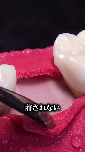 45秒でわかるインプラント治療の流れ