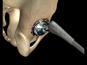 Summit Hip System | Hip Replacement Surgery | Animation Demo