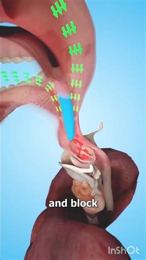 🤔What Happens If Your Uvula Is Too Long?#shorts​ #youtubeshorts #ytshorts​ #facts​