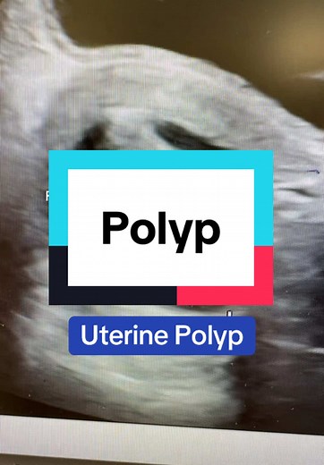 Understanding Uterine Polyps and Their Removal Process