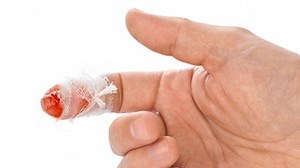 Les plaies de la phalange distale - Institut Français de Chirurgie de la Main