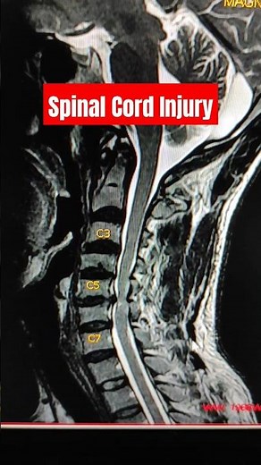 Spinal Cord Injury Explained #shorts #ytshorts #mri #medicine