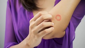 Ringworm Treatment: ದದ್ದು, ತುರಿಕೆ ಮತ್ತು ರಿಂಗ್ವರ್ಮ್ ನಿಂದ ಪರಿಹಾರ ಪಡೆಯುವುದು ಹೇಗೆ?