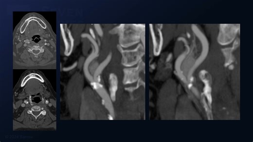 #353: Transcervical Approach for Resection of a Carotid Body Tumor and Carotid Endarterectomy - All Videos - Seven Series Collection