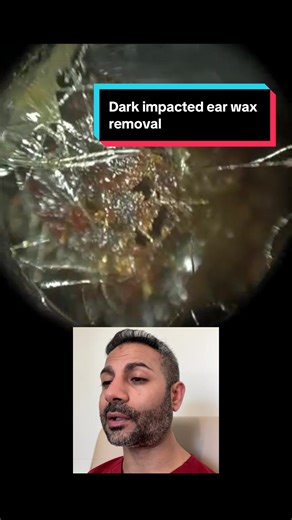 Dark impacted ear wax removal using the WAXscope®. Cleared safely with magnified HD vision. Performed by Consultant Audiologist Mr Neel Raithatha at The Hear Clinic. #earwax #earwaxremoval #blockedear #audiology #medical
