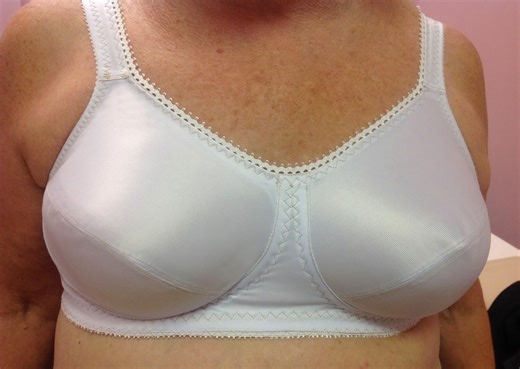 breast prosthesis surgery after mastectomy