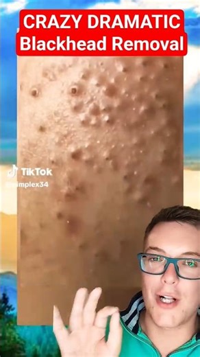 EPIC BLACKHEAD REMOVAL - Record Number of Blackhead Pops #shorts