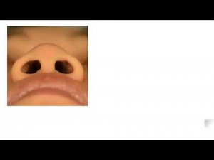 Asian Rhinoplasty - Alar Base Modification & Reduction