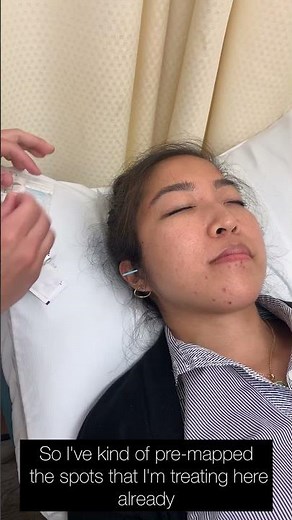 Acupuncture for TMJ or Jaw Pain