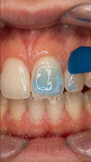 Fixing a Severe White Spot on a Front Tooth Instantly!