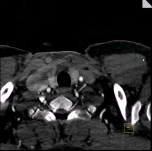 #siemenshealthineers #cinematic_3d #ct_angiography #ct_cardiac #radiology #imaging #coronary #cardiac #medical_imaging #ct #syngovia #angiography #postprocessing #ct_technologist #flashacquisition… | Mohamed Elboraey