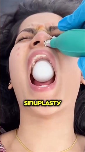 How Doctors Use a Balloon to Fix Sinuses😳